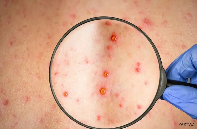 Qızılca xəstəliyinə yoluxma kəskin artıb