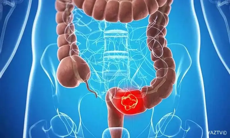 Hansı bağırsaq şişləri ən təhlükəlidir?
