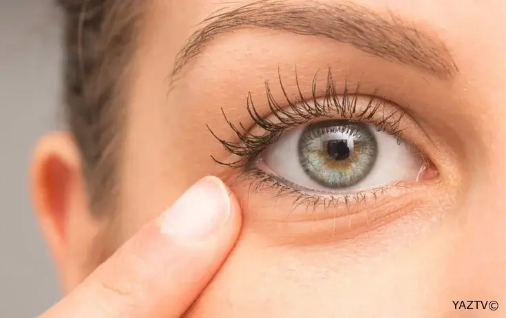 Qozaltı torbalardan xilas olmaq üçün bunları edin