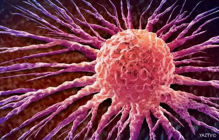 Süd vəzi xərçənginin yayılması irsi ola bilər - TƏDQİQAT